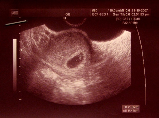 Пять недель беременности фото плода узи