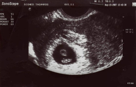 Фото узи в 6 недель беременности фото