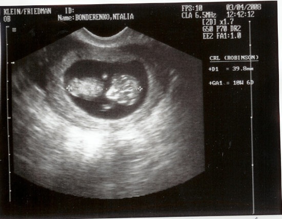 На 11 неделе тянет. 11 Недель беременности фото плода на УЗИ. УЗИ плода на 11-12 неделе беременности. Фото плода на 11 неделе беременности фото УЗИ. Эмбрион на 11 неделе беременности УЗИ.