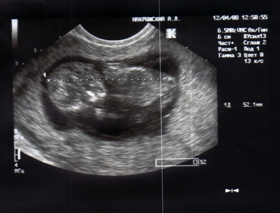 Беременность 12 недель фото узи фото