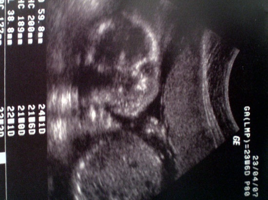Фото узи на 25 неделе беременности
